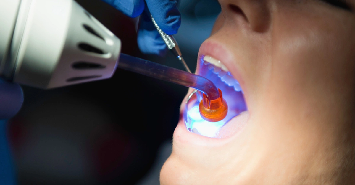 composite resin tooth fillings treatment