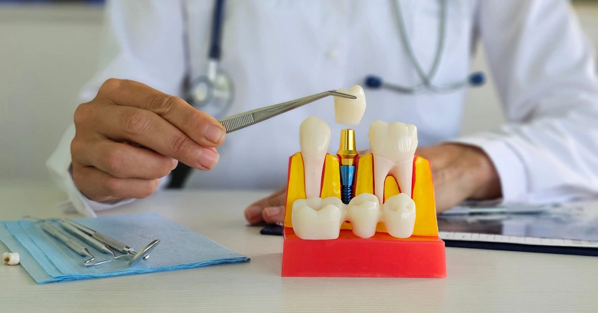 what is dental implants