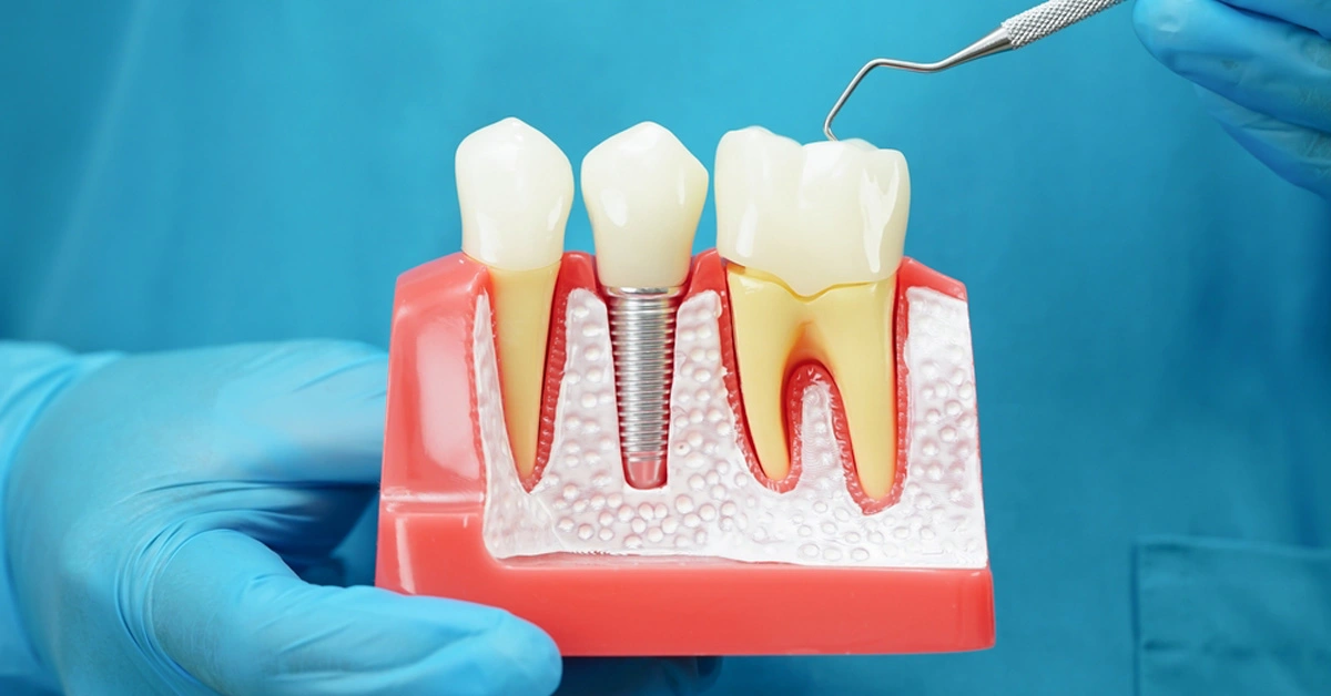 dental implants cost in india