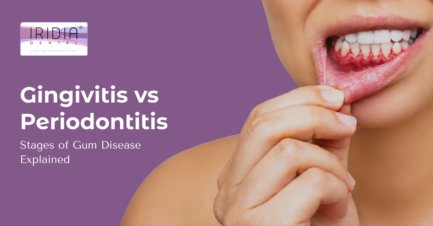 gingivitis vs periodontitis gum disease