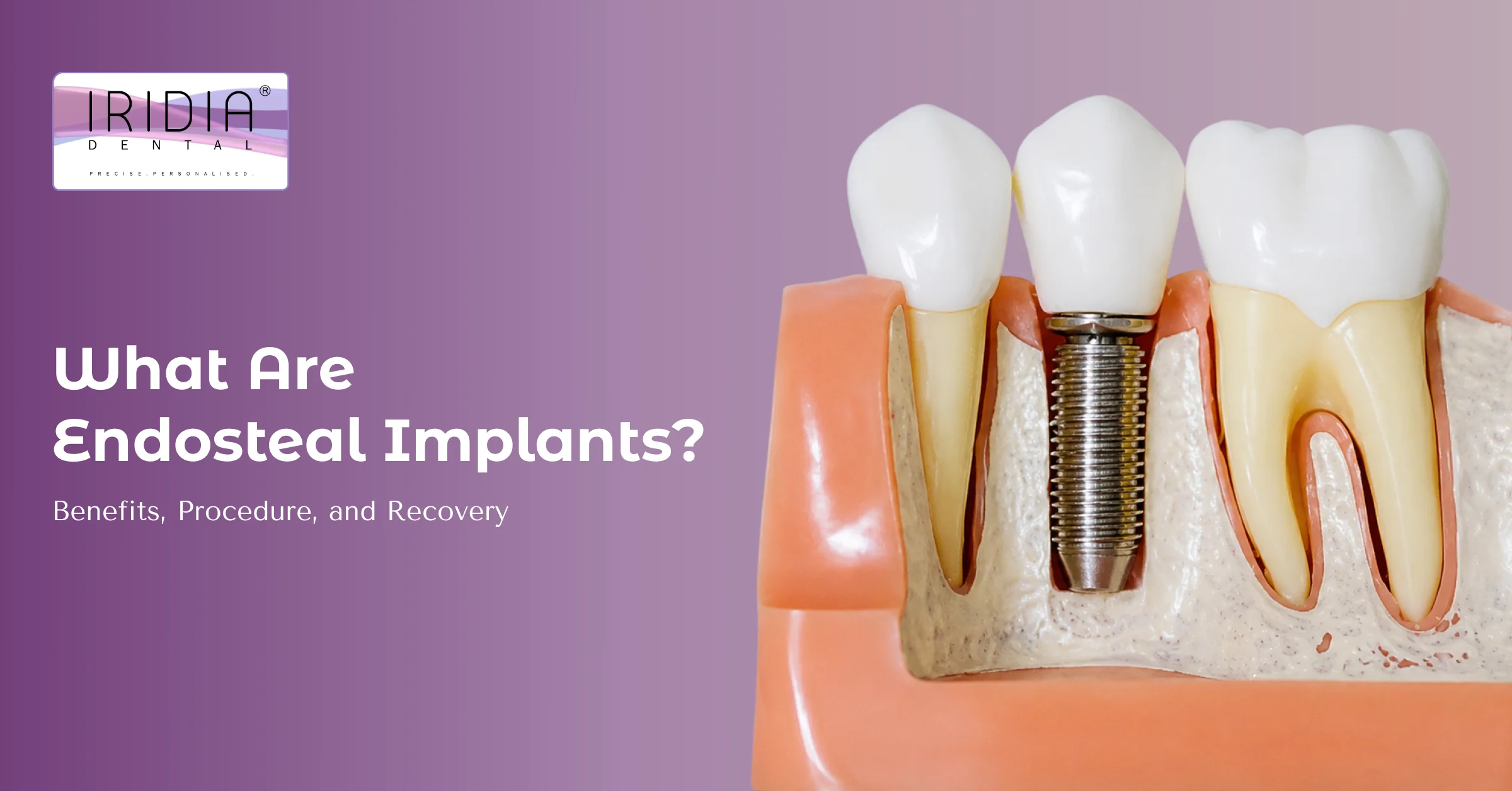 endosteal-implants