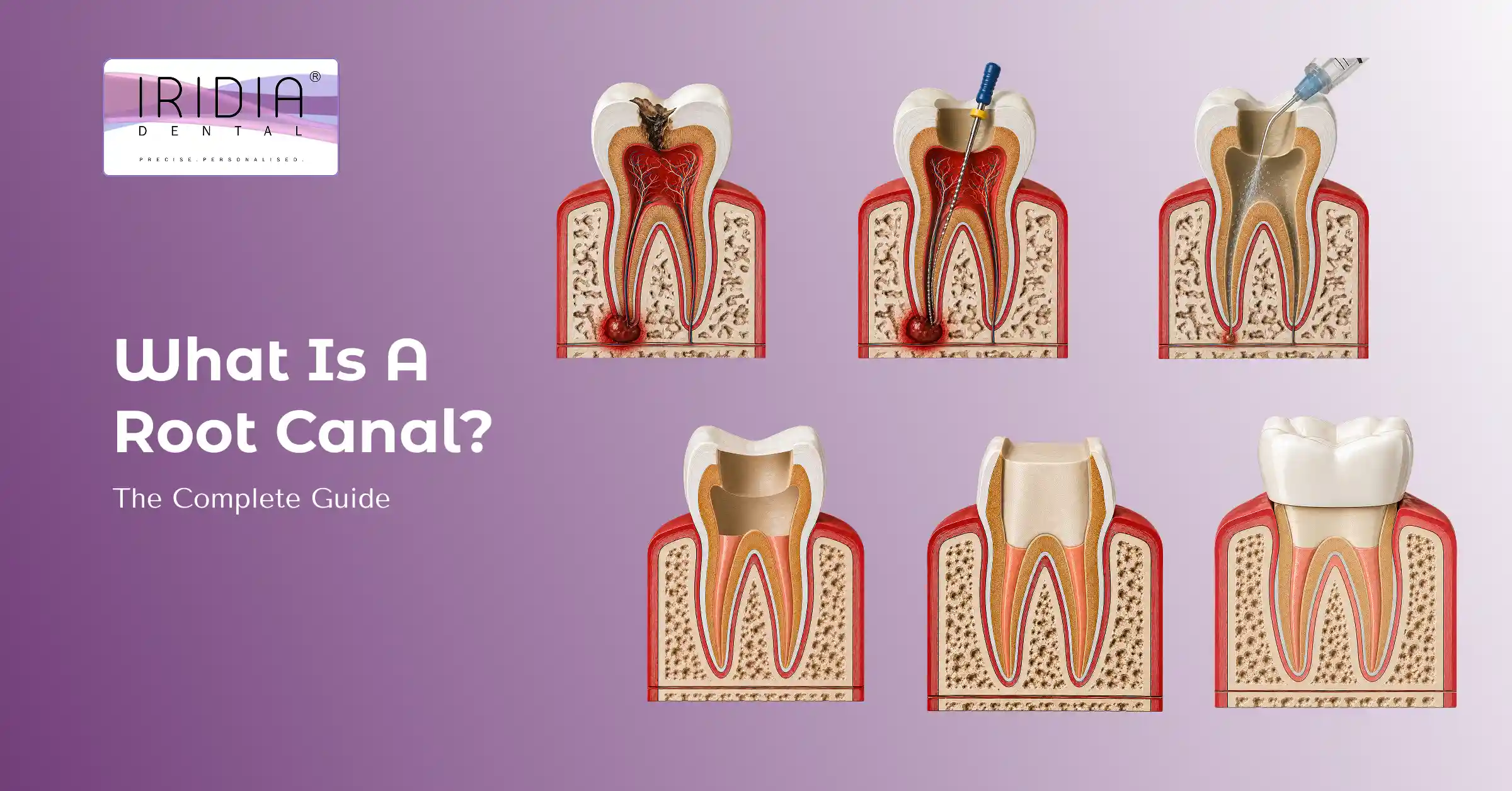 what is root canal
