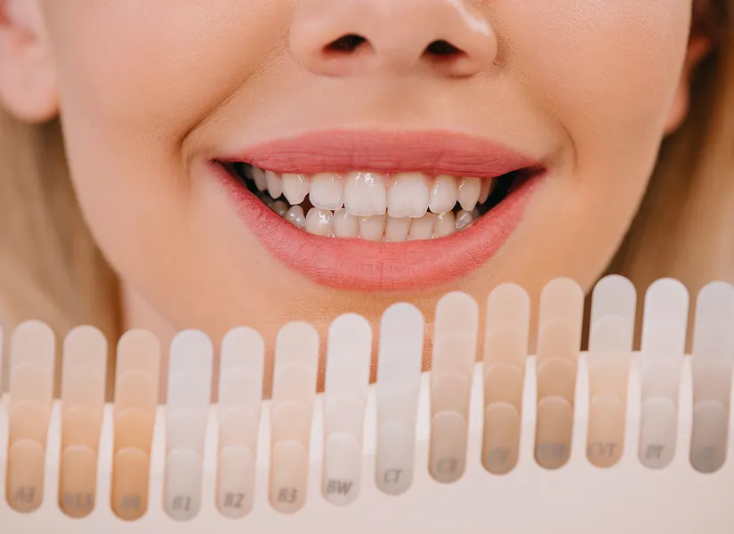 Are You a Suitable Candidate for Teeth Whitening