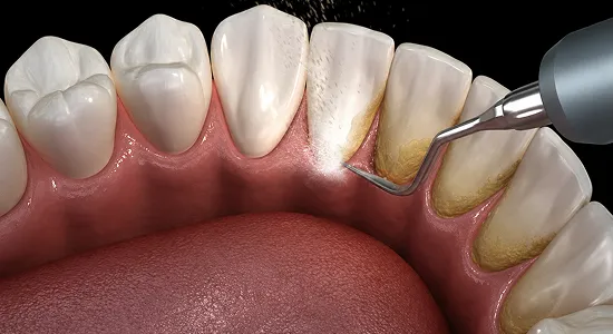 What is Teeth Cleaning?